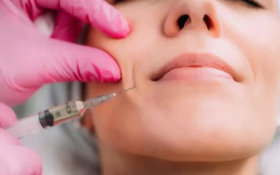 Redefiniendo la Armonía Facial: El Relleno de Surcos Nasogenianos